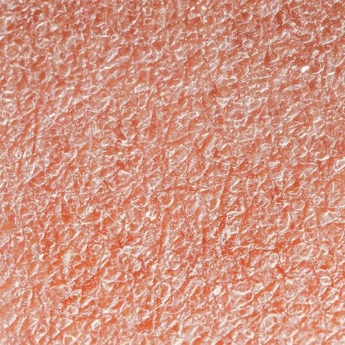 Dry Skin