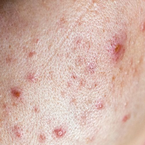 Breakout-Prone Skin