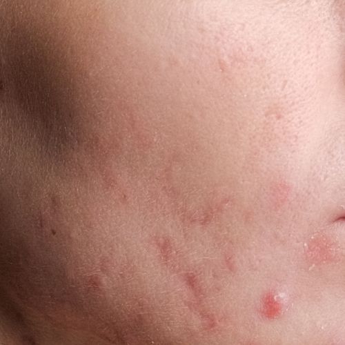 Combination Skin