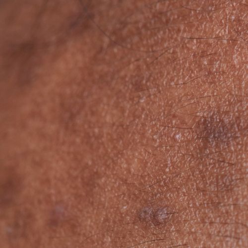 Dull & Uneven Skin