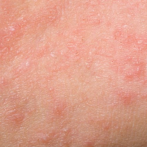 Compromised Skin Barrier