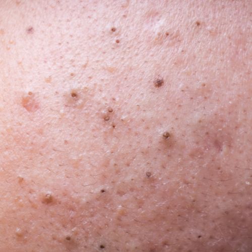 Blackheads and Whiteheads
